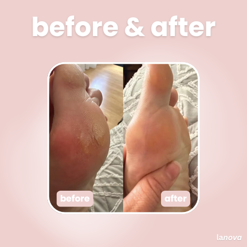 lanova callus remover