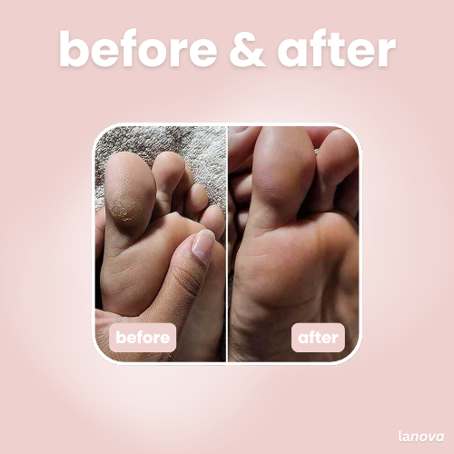 lanova callus remover